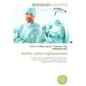  Aortic valve replacement (9786133730885) Books
