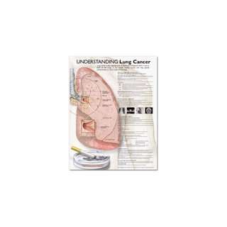 Understanding Lung Cancer Anatomical Chart  paper unmounted  